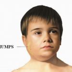 Mumps Spell